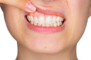 Parodontite: chi ha il diabete rischia di pi&ugrave;