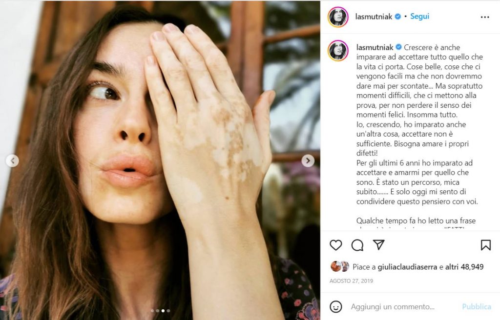 Vitiligine: le star che hanno fatto delle macchie bianche sulla pelle un simbolo di unicità 2 kasia-smutniak-vitiligine