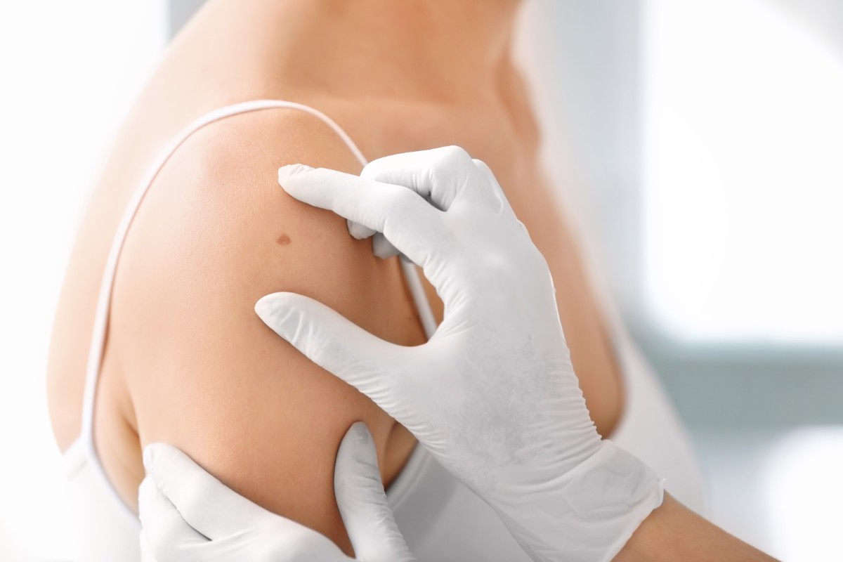Melanoma: circa il 90% di guarigioni, ma aumentano i casi tra gli under 40 2 melanoma quaderno