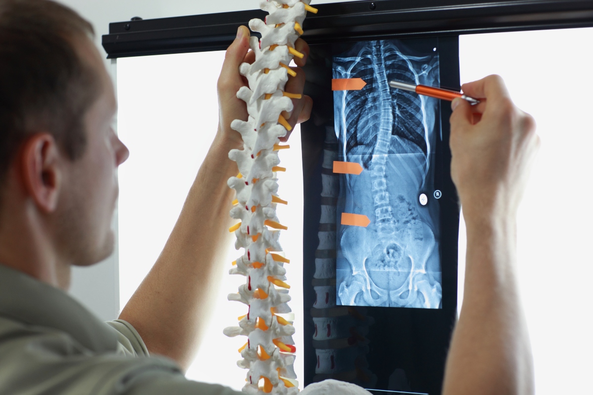 Scoliosi: cos'è, classificazioni, cause, sintomi e cura 7 scoliosi: diagnosi