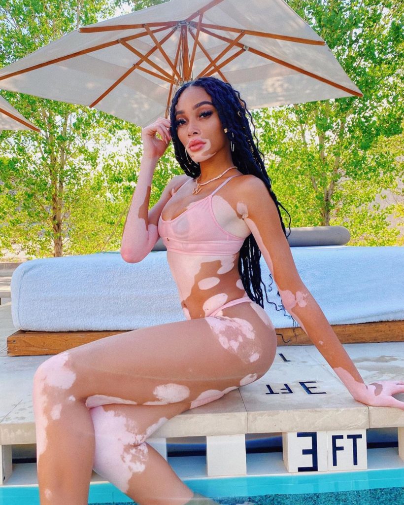 Vitiligine: le star che hanno fatto delle macchie bianche sulla pelle un simbolo di unicità 1 vitiligine winnie harlow