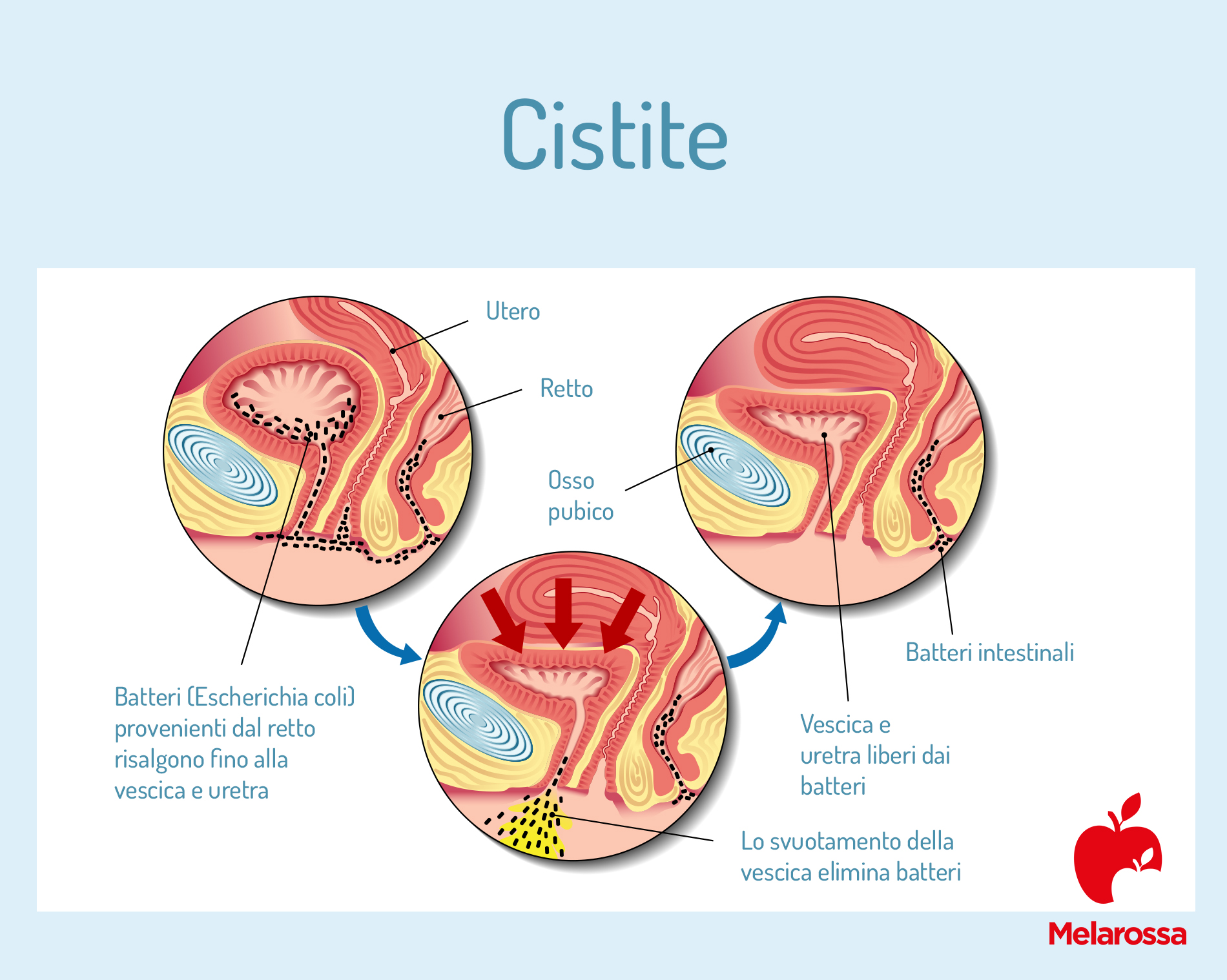 Cistite: sintomi, cause e rimedi 1 Cistite
