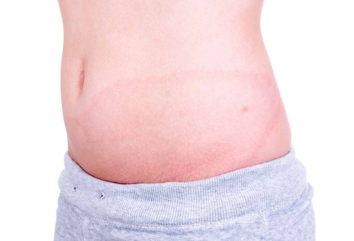 Malattia di Lyme: cos'è, cause e fattori di rischio, sintomi, diagnosi, cure e prevenzione 4 malattia di Lyme: come riconoscere un morso di zecca