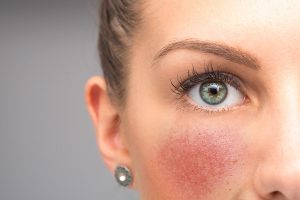 Dermatite seborroica: come evitare che si aggravi con le mascherine