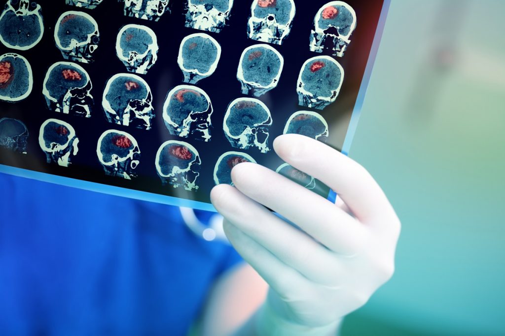 Si sveglia da un ictus e parla con accento slavo 1 ictus cerebrale