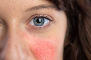 Lupus eritematoso sistemico (LES): cos&rsquo;&egrave;, cause, sintomi, diagnosi, cura e prevenzione