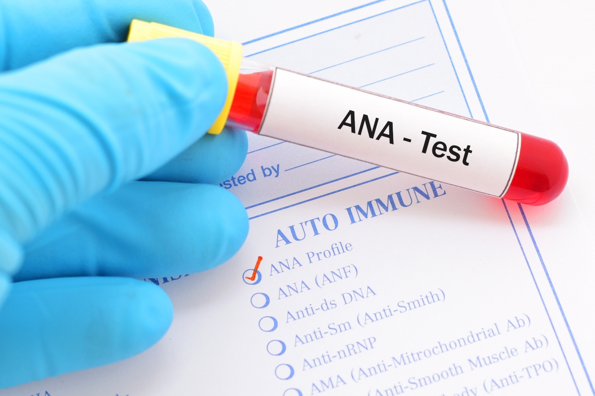 Lupus eritematoso sistemico (LES): cos'è, cause, sintomi, diagnosi, cura e prevenzione 3 lupus: esami da fare