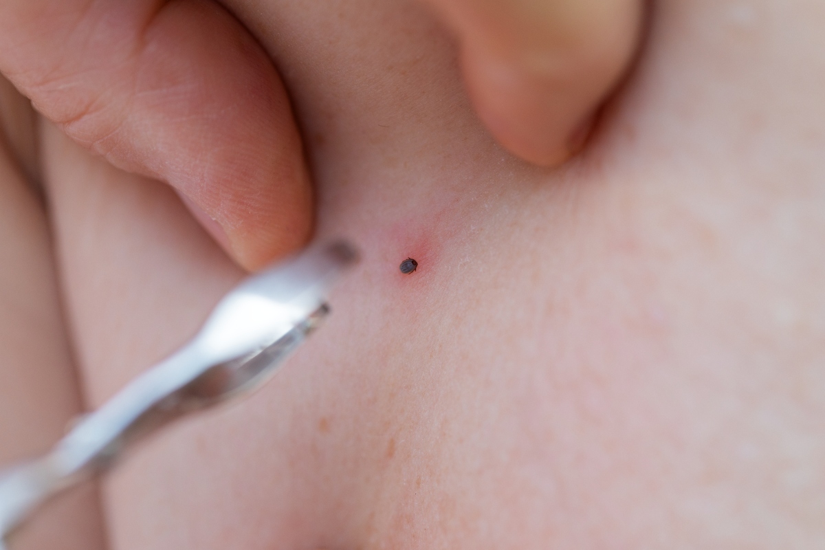 Malattia di Lyme: cos'è, cause e fattori di rischio, sintomi, diagnosi, cure e prevenzione 1 malattia di Lyme: epidemiologia in Italia