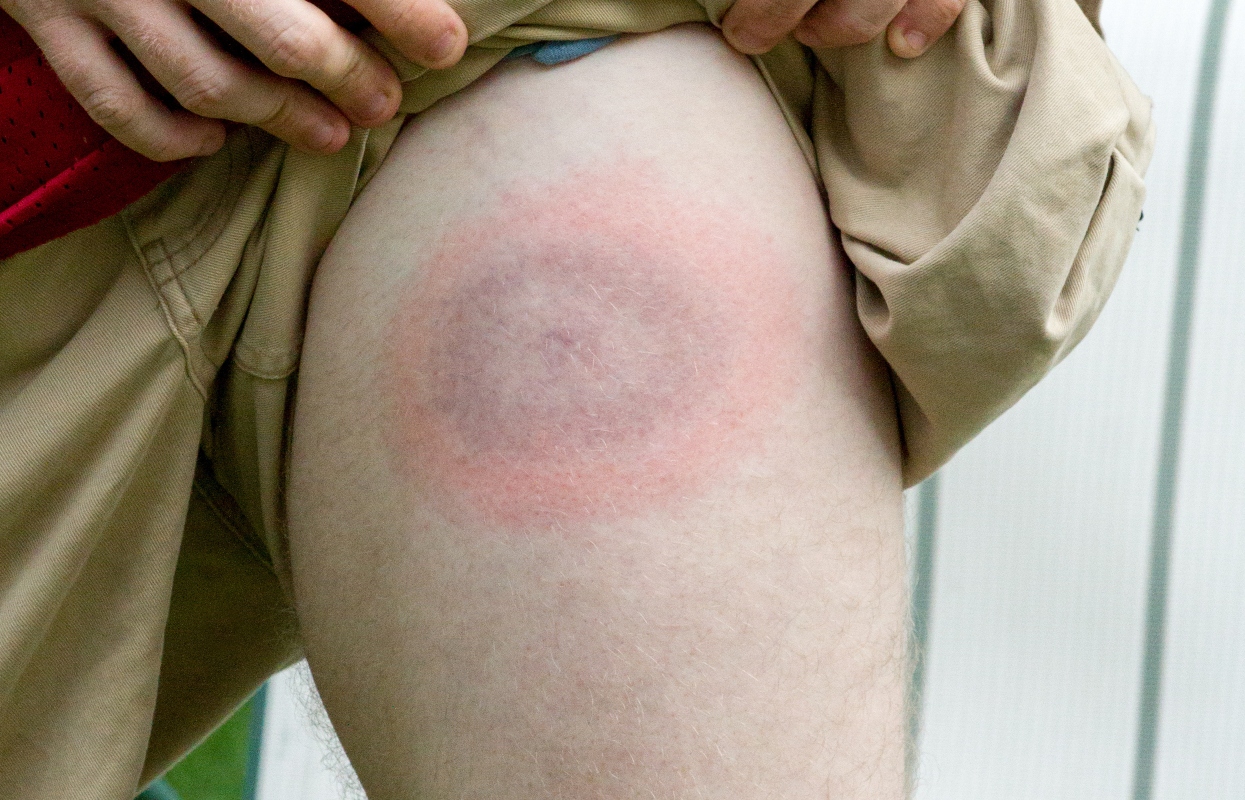 Malattia di Lyme: cos'è, cause e fattori di rischio, sintomi, diagnosi, cure e prevenzione 3 malattia di Lyme: cause e fattori di rischio