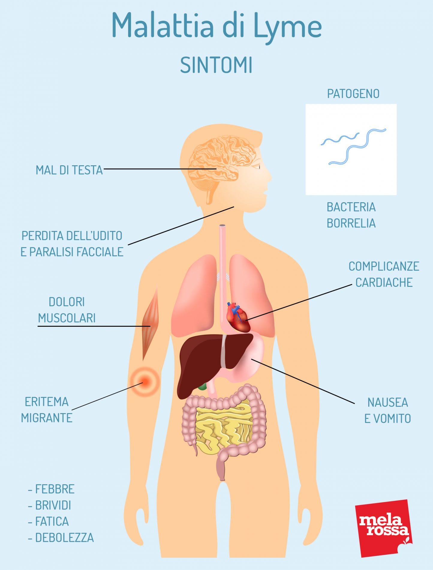 Malattia di Lyme: cos'è, cause e fattori di rischio, sintomi, diagnosi, cure e prevenzione 5 malattia di Lyme: sintomi