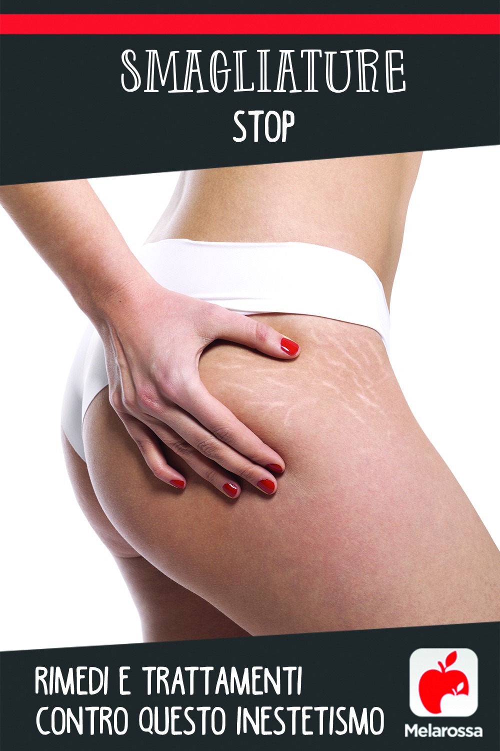 Smagliature: cosa sono, cause, rimedi e trattamenti a casa e dal dermatologo, dieta e prevenzione 22 Smagliature: rimedi e trattamenti contro questo inestetismo