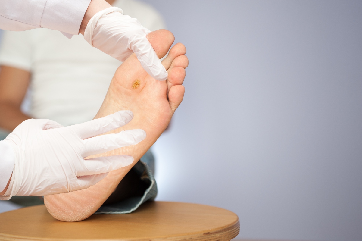 Verruche: cosa sono, sintomi, cause, cura e come prevenirle 2 verruche: classificazione