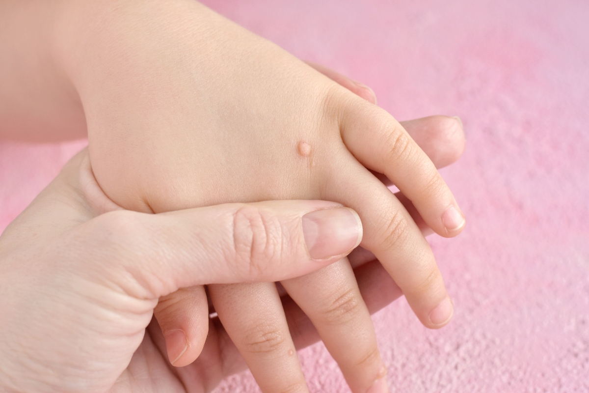 Verruche: cosa sono, sintomi, cause, cura e come prevenirle 4 verruche: diagnosi