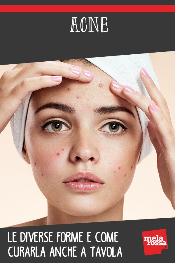 Acne: le diverse forme e come curarla anche a tavola 2 ACNE