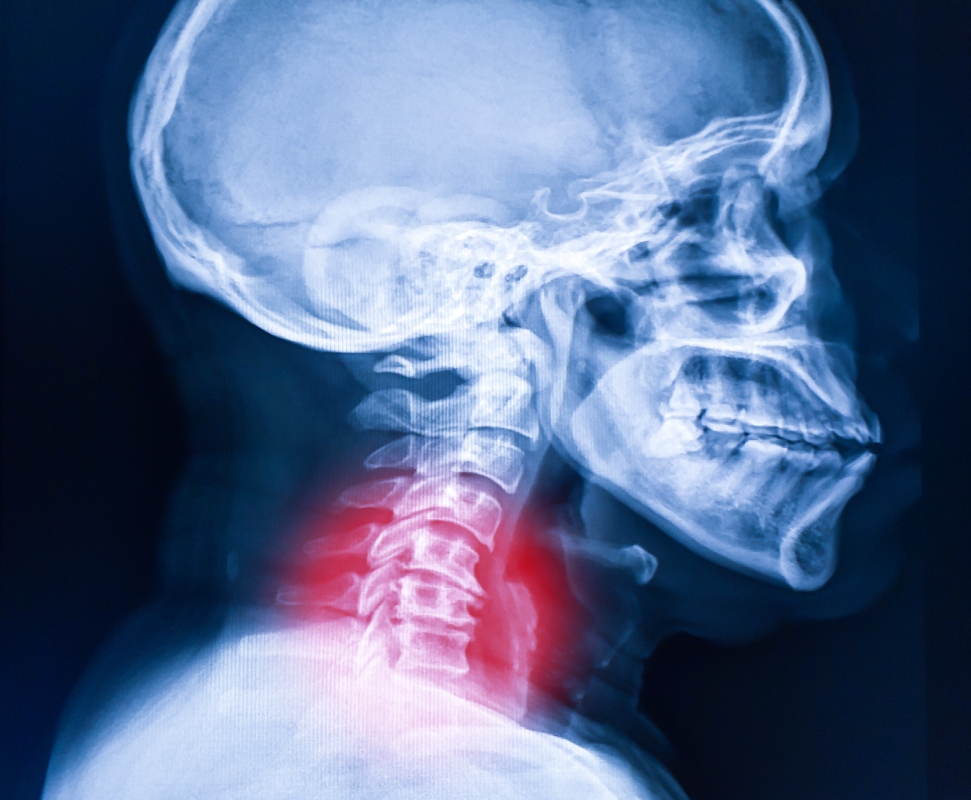 Artrosi cervicale: cos'è, cause, fattori di rischio, sintomi e cura 1 artrosi cervicale, cos'è