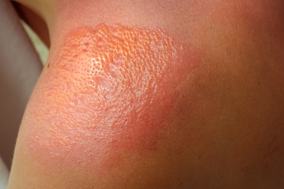 Lupus eritematoso sistemico (LES): cos'è, cause, sintomi, diagnosi, cura e prevenzione 1 lupus: sintomi