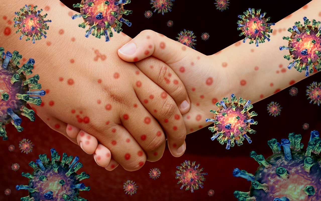 Morbillo: cos'è, cause, sintomi, diagnosi, decorso, e cure 2 morbillo: cause e contagio