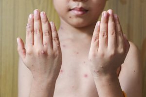 Morbillo: cos&rsquo;&egrave;, cause, sintomi, diagnosi, decorso, e cure