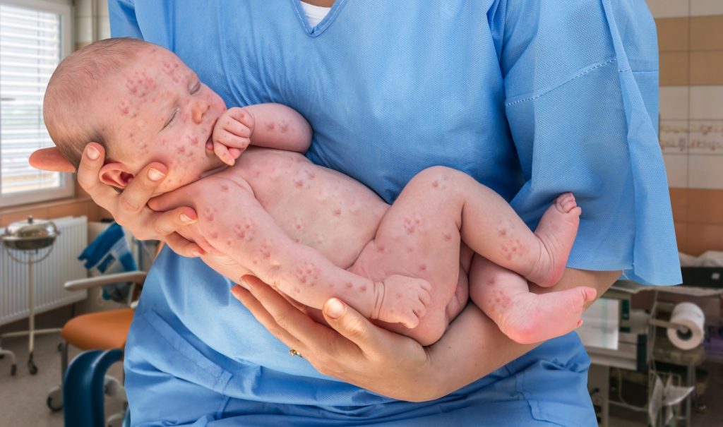 Morbillo: cos'è, cause, sintomi, diagnosi, decorso, e cure 1 morbillo: epidemiologia