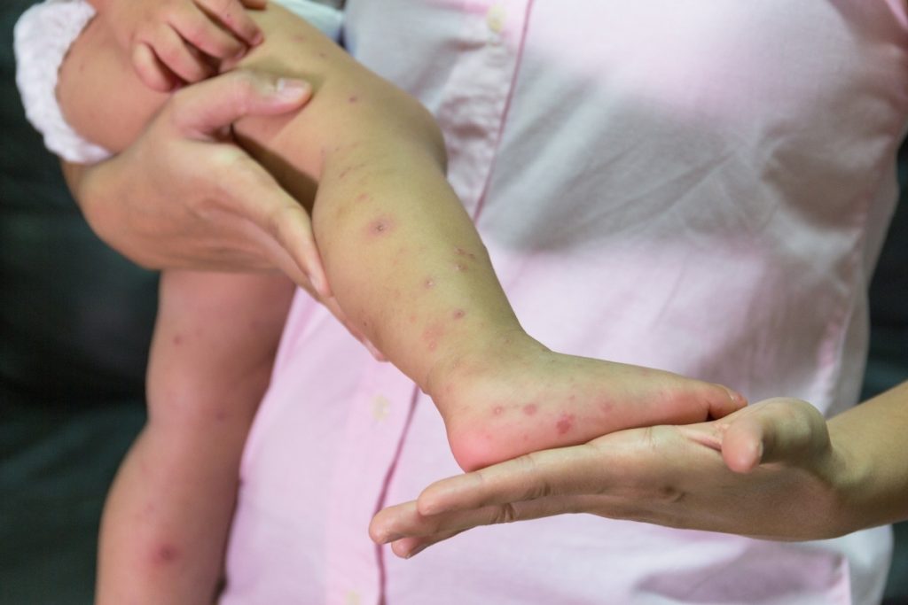 Morbillo: cos'è, cause, sintomi, diagnosi, decorso, e cure 7 morbillo: farmaci e trattamenti
