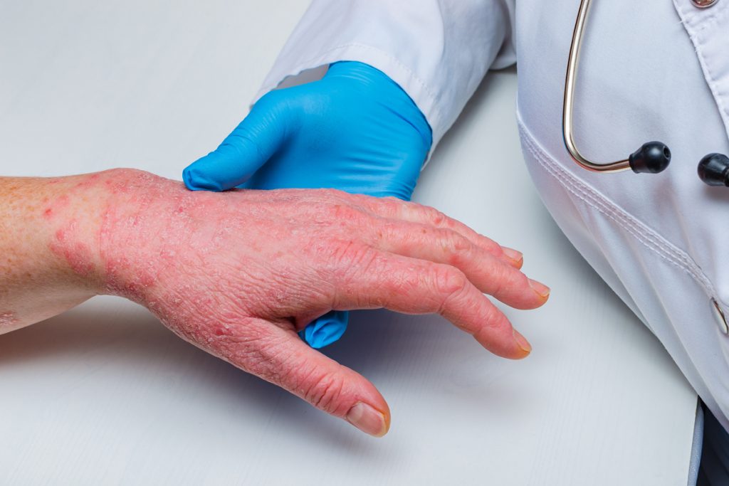 Dermatite atopica: il 26 settembre parte la campagna "Dalla parte della tua pelle" 1 dermatite atopica adulto