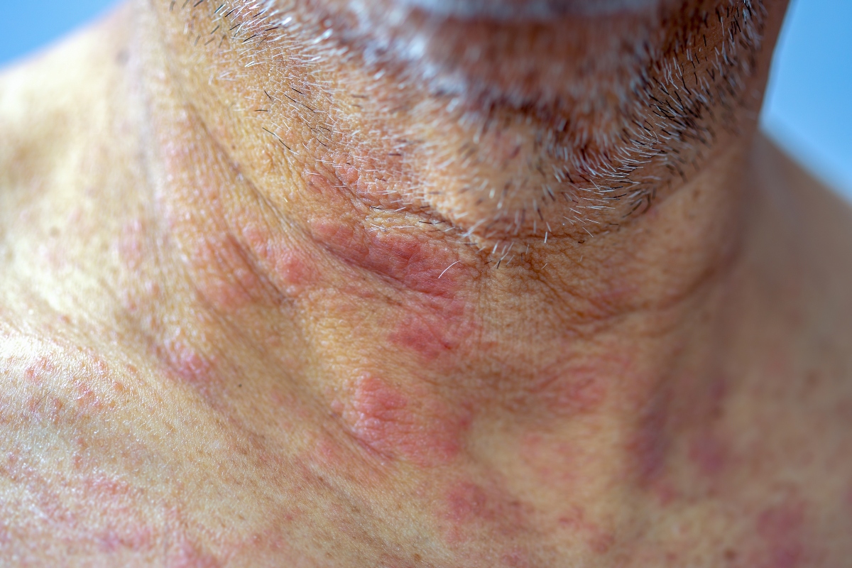 Eczema: cos'è, tipi, sintomi, cause, diagnosi e cura 5 eczema complicazioni