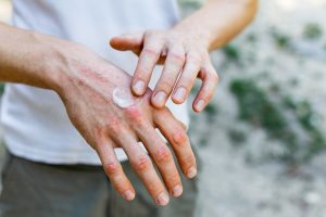 Eczema: cos&rsquo;&egrave;, tipi, sintomi, cause, diagnosi e cura