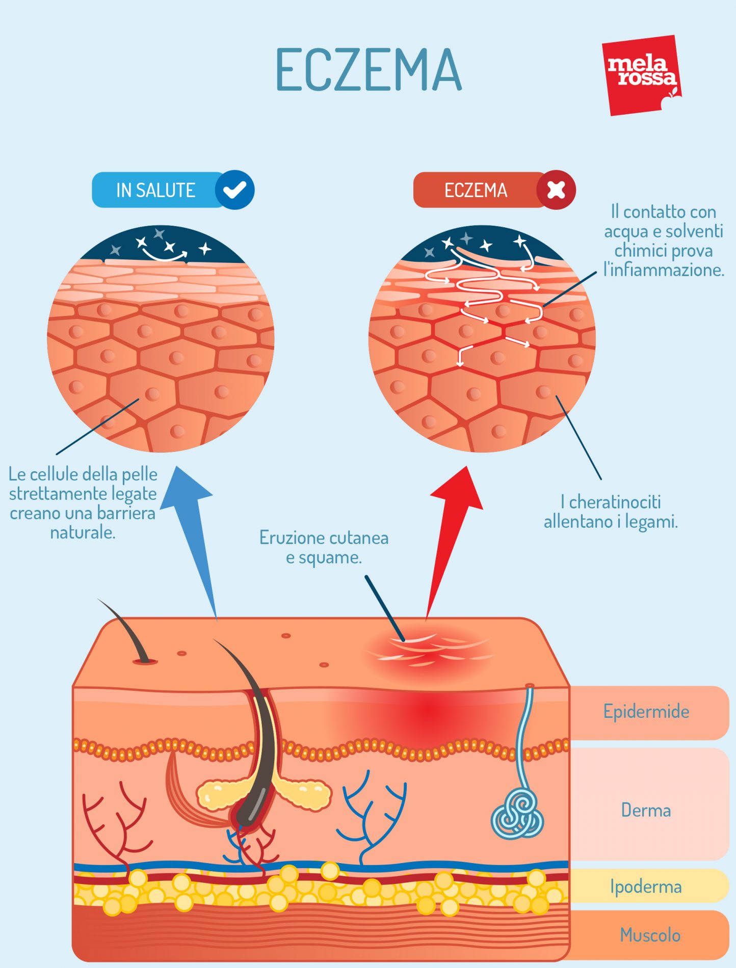 Eczema: cos'è, tipi, sintomi, cause, diagnosi e cura 1 Eczema: cos'è