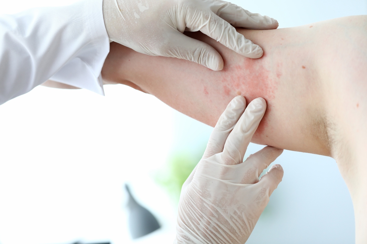 Eczema: cos'è, tipi, sintomi, cause, diagnosi e cura 6 eczema diagnosi