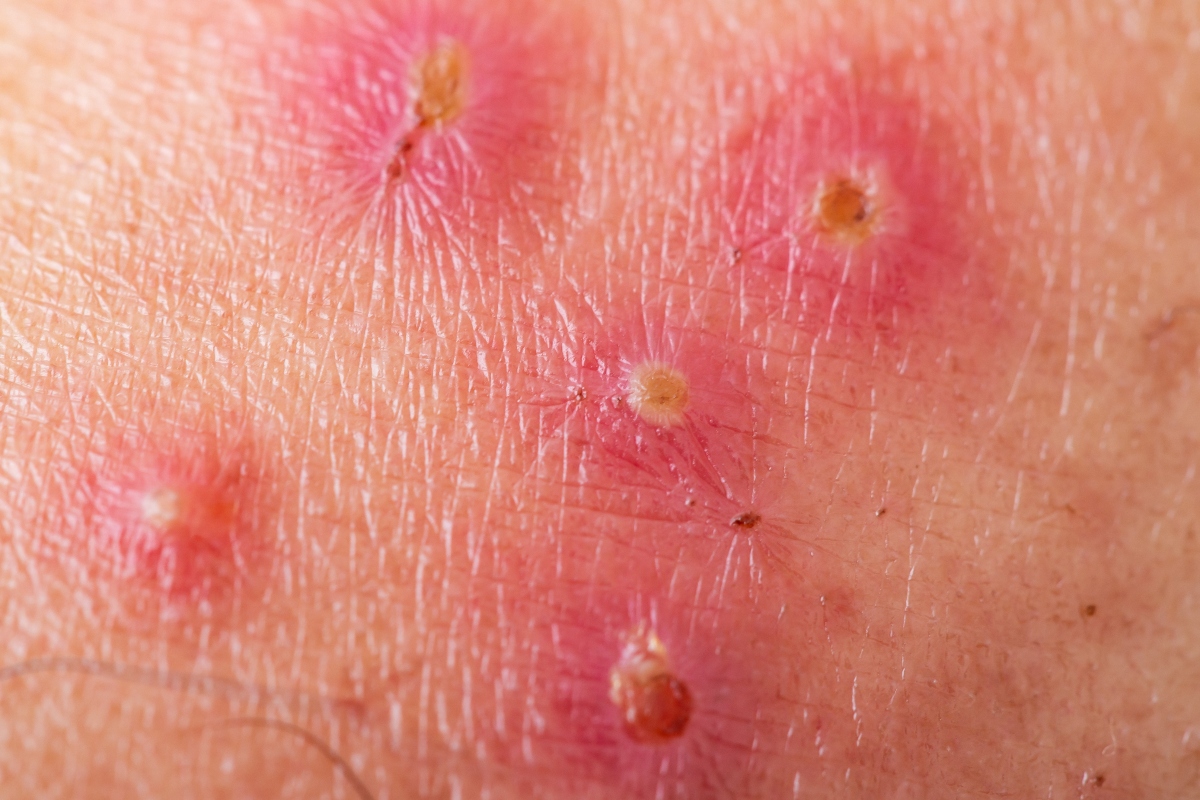Impetigine: cos'è, cause, sintomi e cure 4 impetigine: sintomi