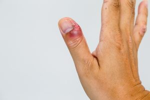 Patereccio (o giradito): cos&rsquo;&egrave;, sintomi, cura prevenzione