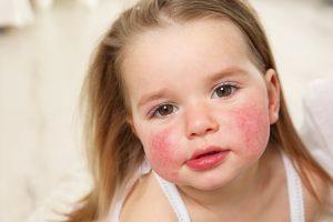 Quinta malattia: cos&rsquo;&egrave;, trasmissione e contagio, sintomi, cure e prevenzione