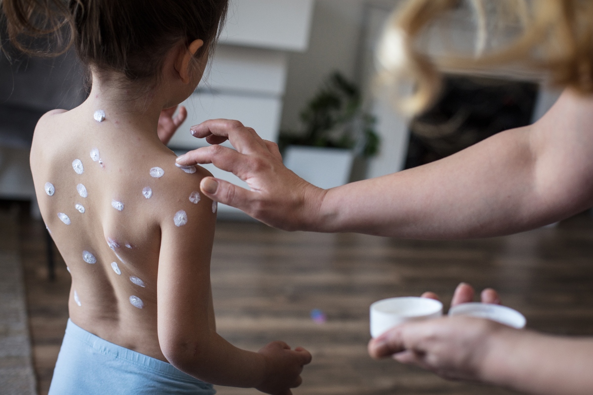 Quinta malattia: cos’è, trasmissione e contagio, sintomi, cure e prevenzione 10 Quinta malattia: cure