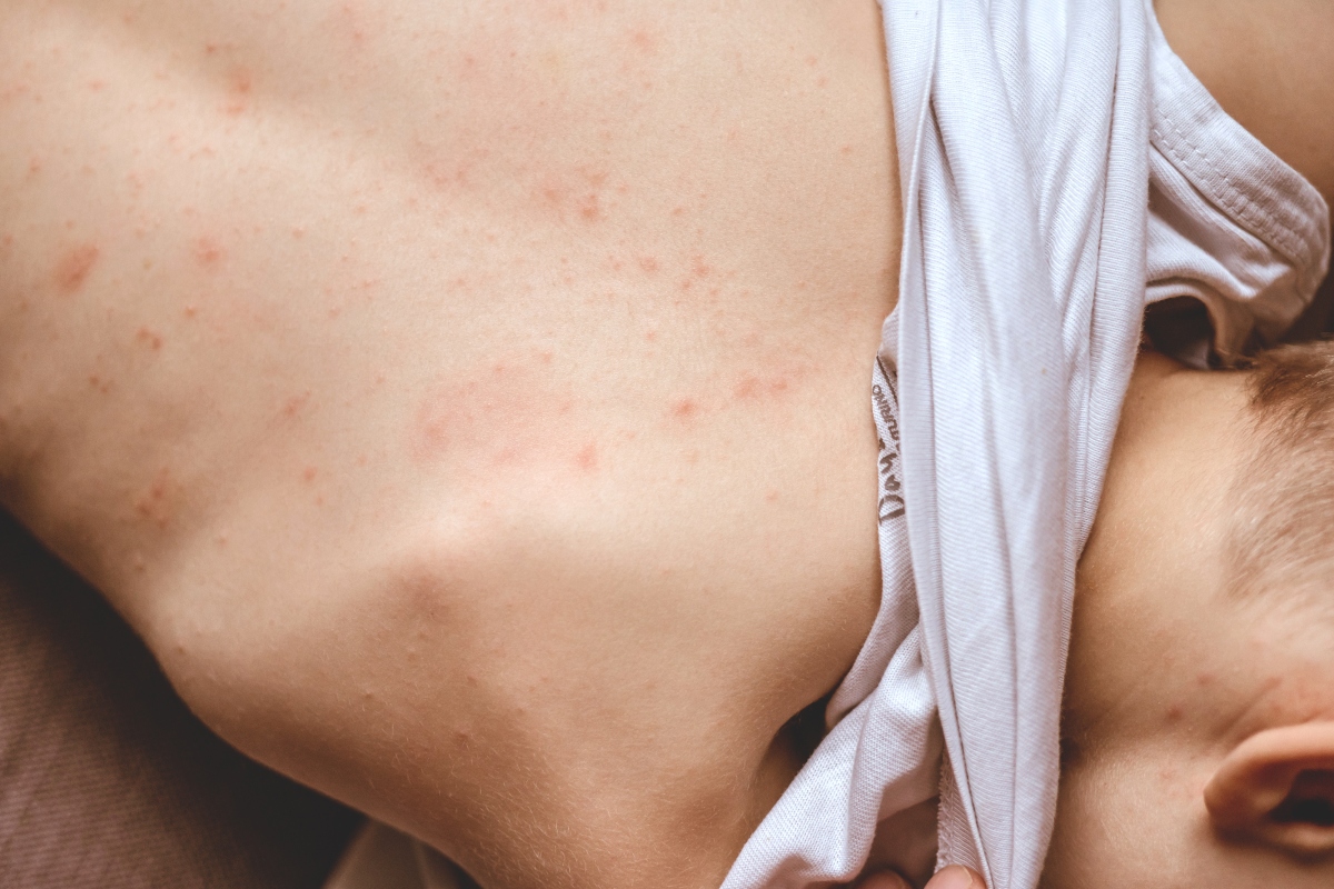 Rosolia: cos'è, cause, contagio, sintomi, diagnosi, cure e prevenzione 2 Rosolia: categorie a rischio