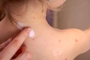 Rosolia: cos&rsquo;&egrave;, cause, contagio, sintomi, diagnosi, cure e prevenzione