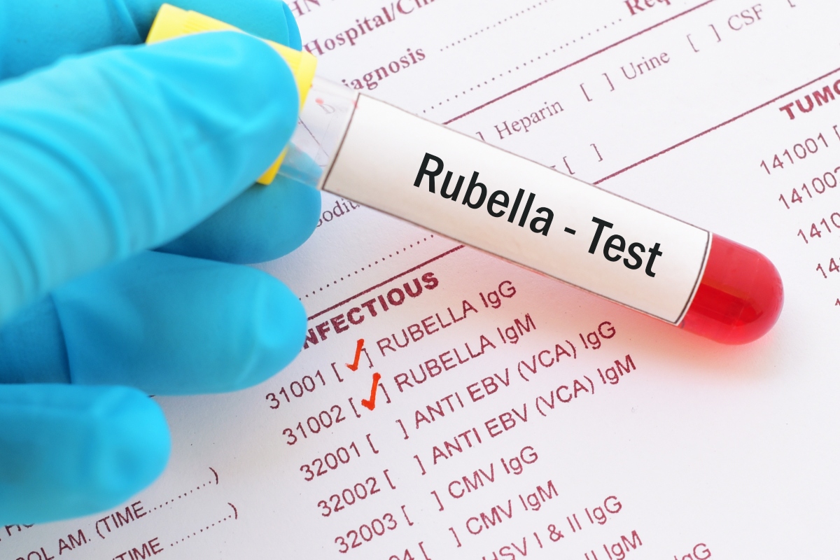 Rosolia: cos'è, cause, contagio, sintomi, diagnosi, cure e prevenzione 8 rosolia: diagnosi