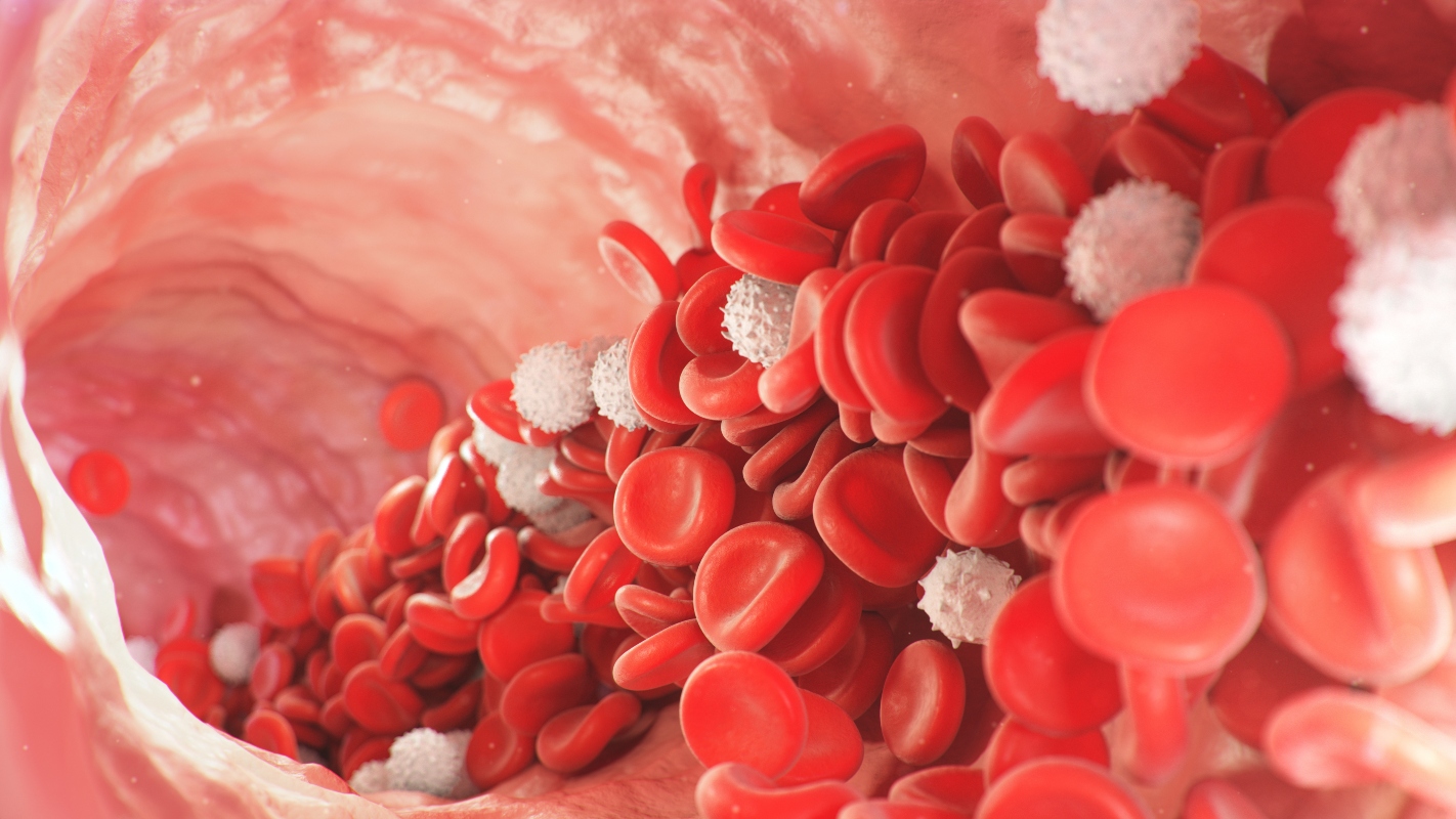 Trombosi: venosa o superficiale, sintomi, cause e come si cura 3 Un'immagine che mostra una trombosi, cioè coagulo di sangue in un vaso