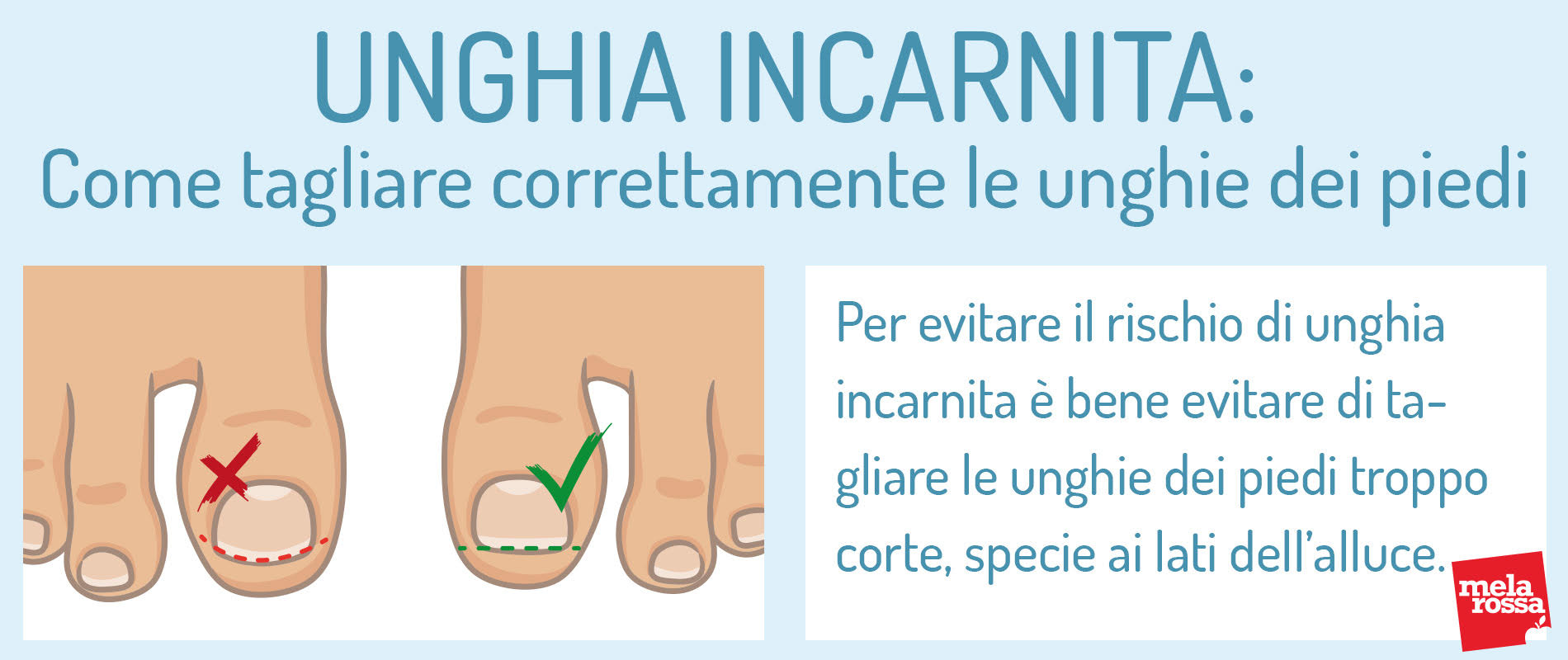 Unghia incarnita: cos'è, cause, sintomi, cure e prevenzione 9 Unghia incarnita: come tagliare correttamente le unghie dei piedi