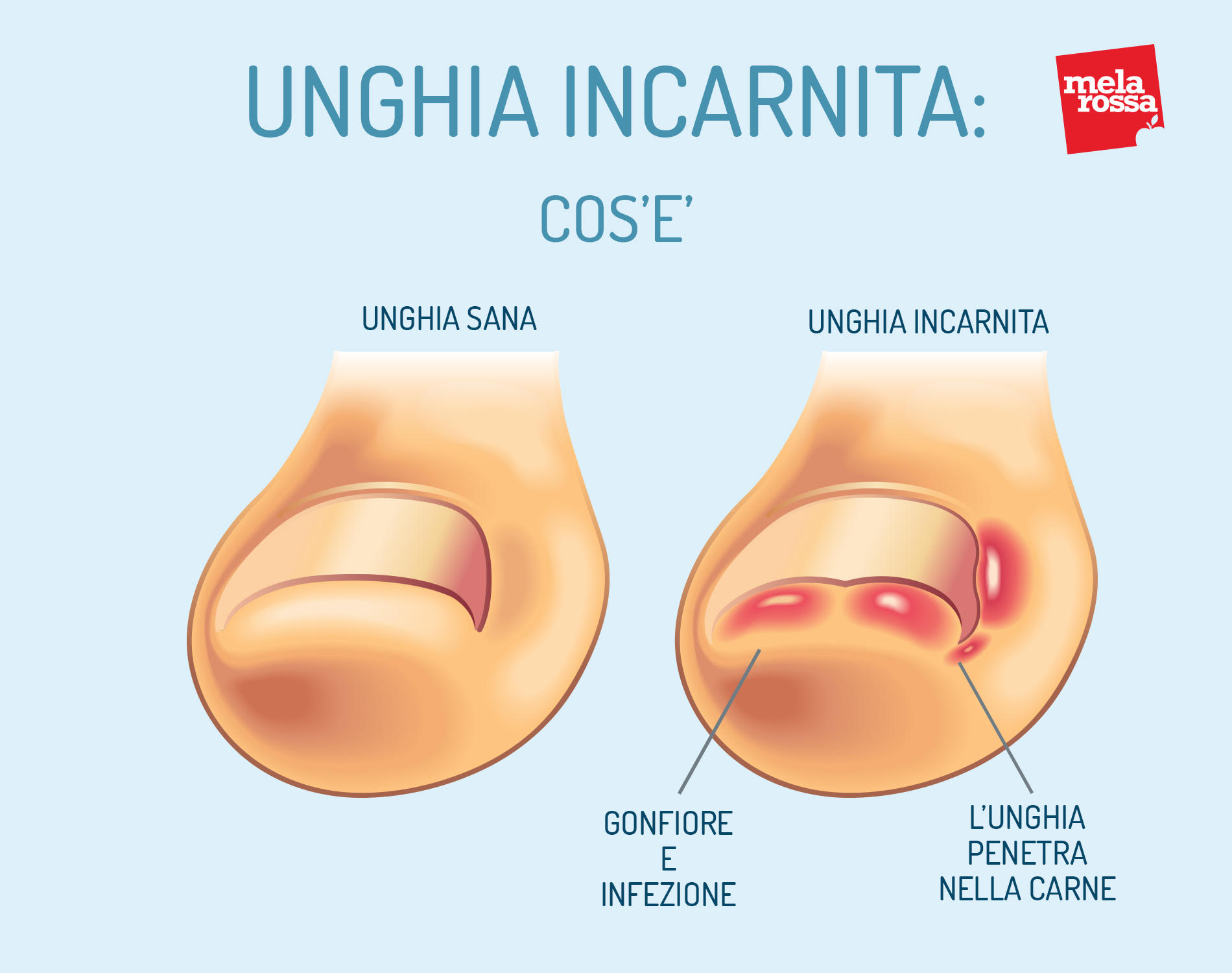 Unghia incarnita: cos'è, cause, sintomi, cure e prevenzione 1 unghia incarnita: che vuole dire