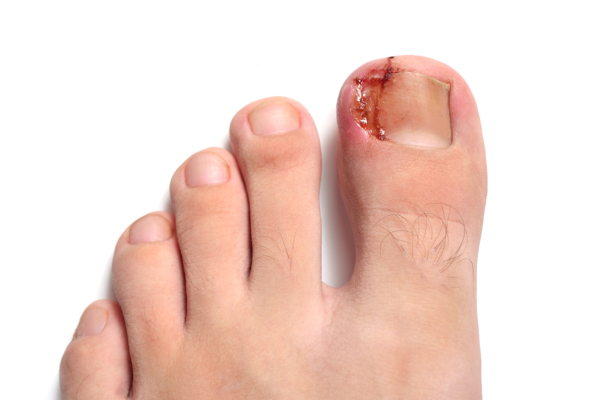 Unghia incarnita: cos'è, cause, sintomi, cure e prevenzione 5 granuloma: unghia incarnita