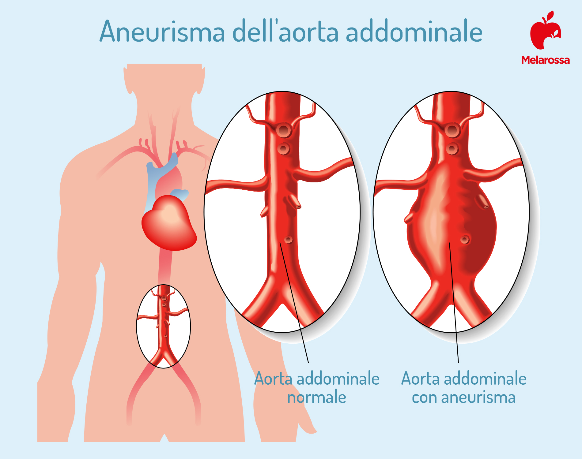 Aneurisma: cos'è, classificazione, tipi, cause, fattori di rischio, trattamenti, decorso e prevenzione 1 aneurisma aorta addominale
