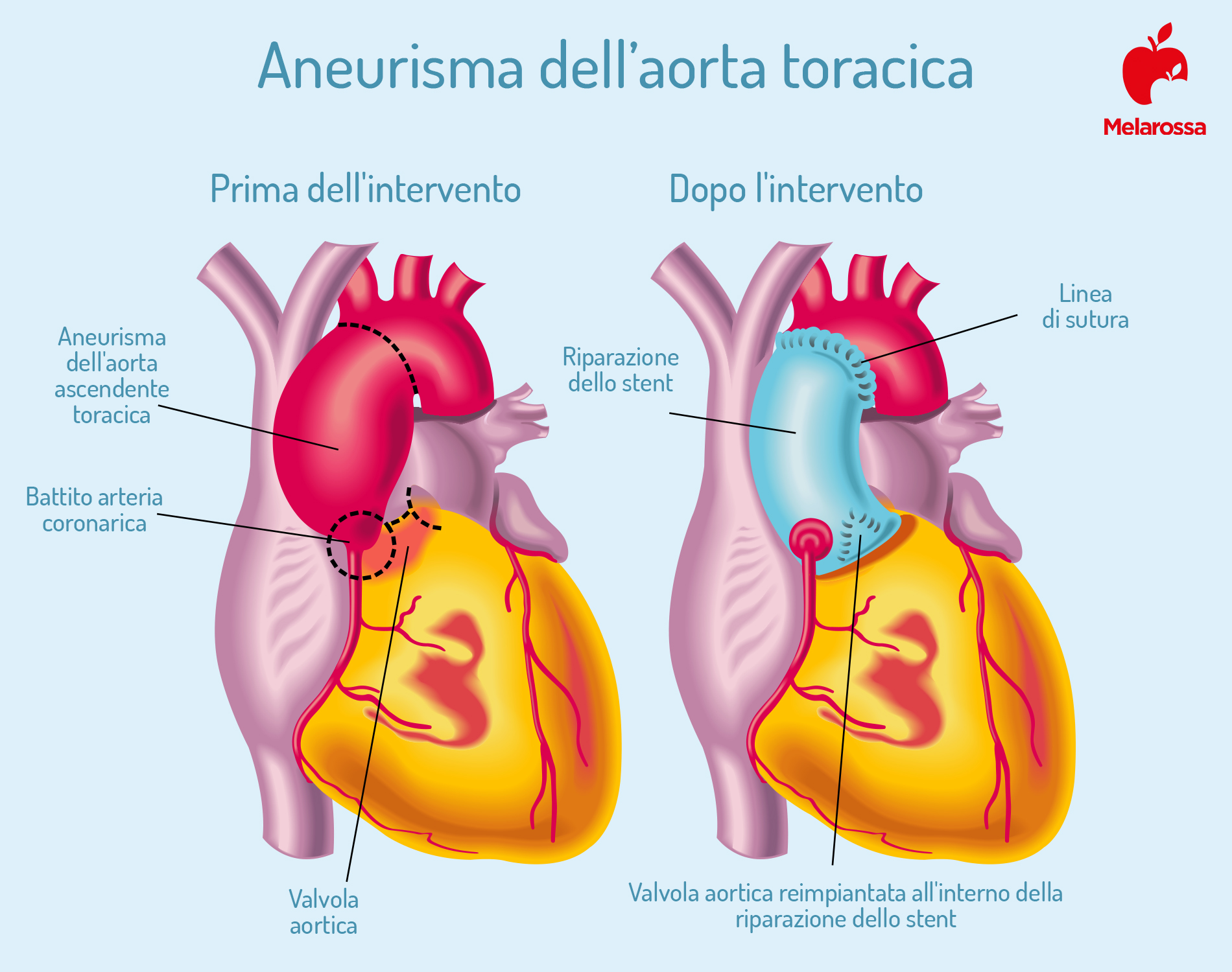 Aneurisma: cos'è, classificazione, tipi, cause, fattori di rischio, trattamenti, decorso e prevenzione 5 aneurisma aorta addominale prima e dopo intervento