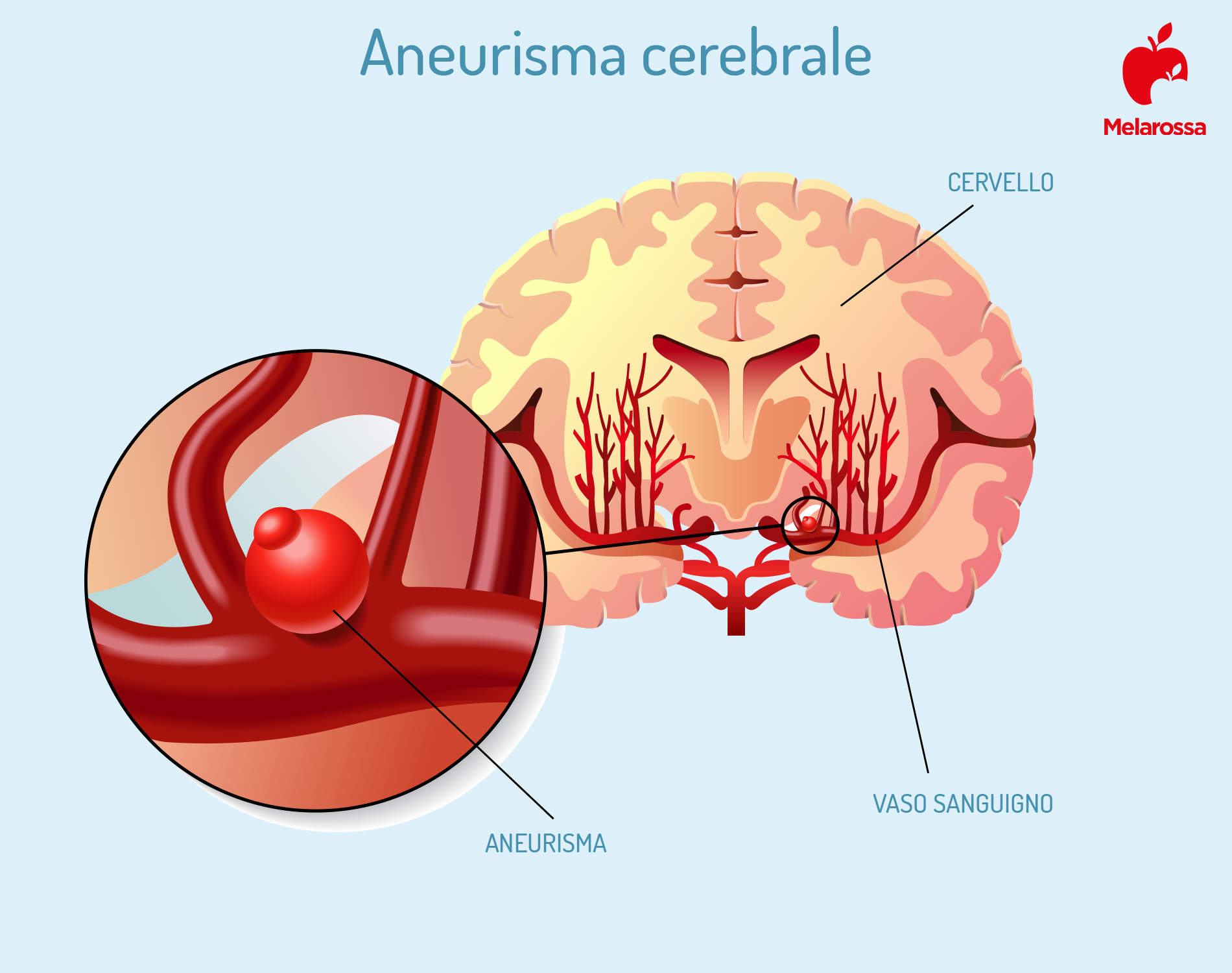 Aneurisma: cos'è, classificazione, tipi, cause, fattori di rischio, trattamenti, decorso e prevenzione 2 aneurisma cerebrale