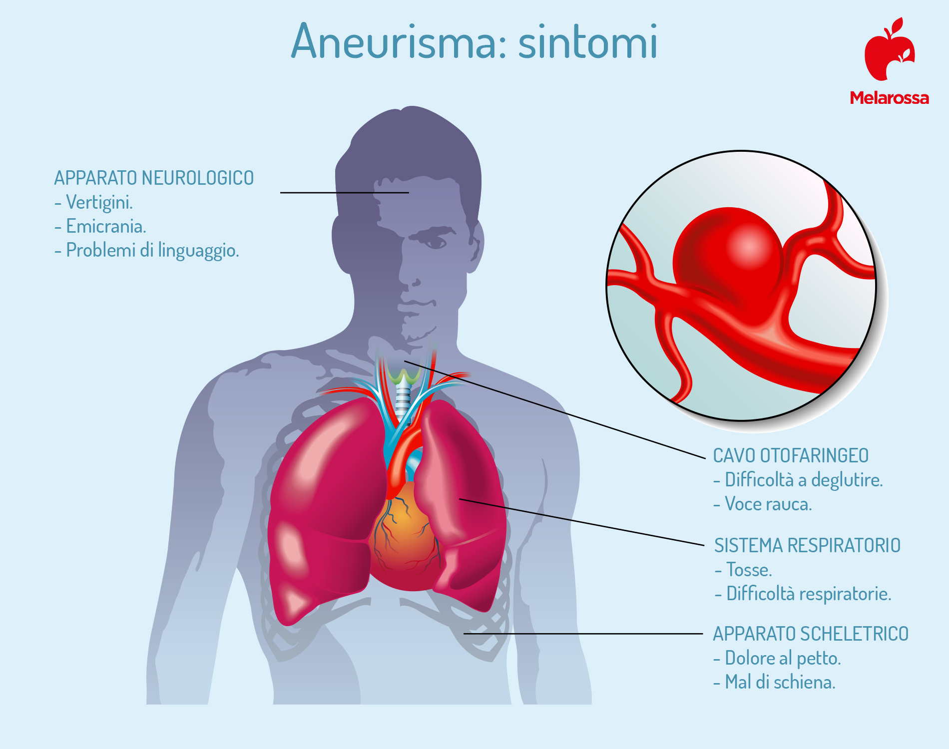 Aneurisma: cos'è, classificazione, tipi, cause, fattori di rischio, trattamenti, decorso e prevenzione 3 i sintomi dell'aneurisma