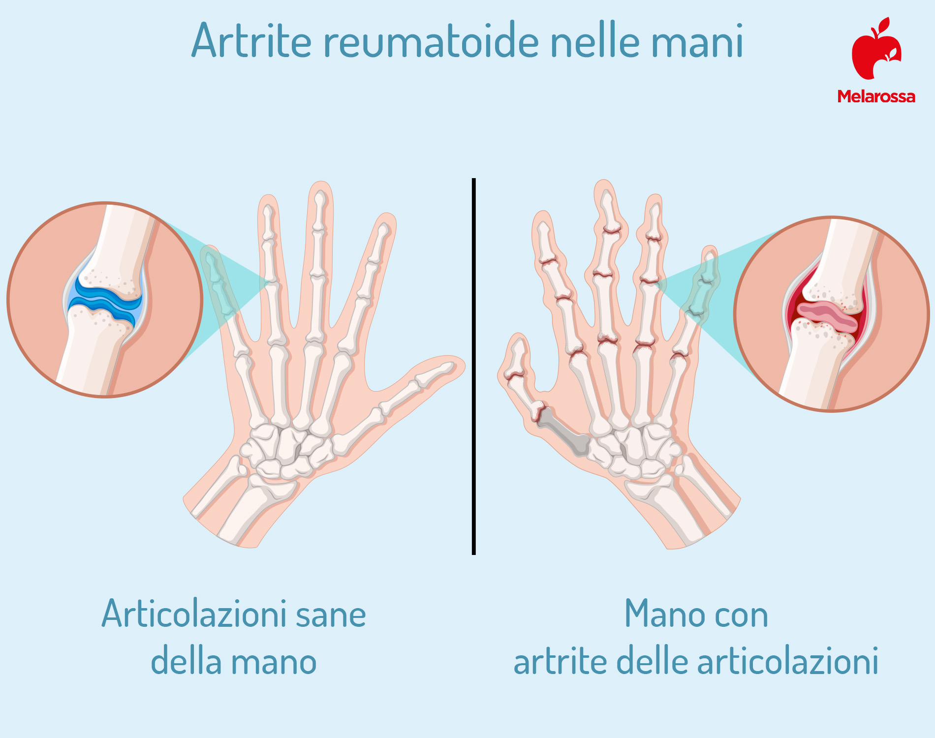 Artrite reumatoide: cos'è, sintomi e come si cura 3 artrite reumatoide: mani
