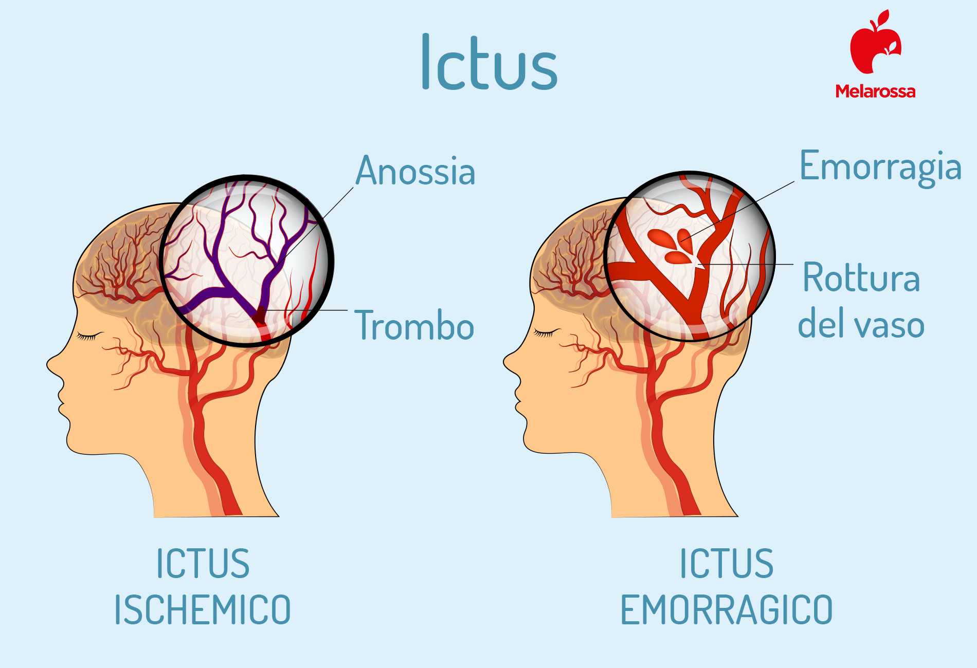 Ictus: cos'è, chi è a rischio, tipi, cause, sintomi, fattori di rischio, cure e prevenzione 3 Ictus: classificazione