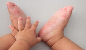 Mani-piedi-bocca: cos&rsquo;&egrave;, contagio, cause, sintomi, cure e prevenzione