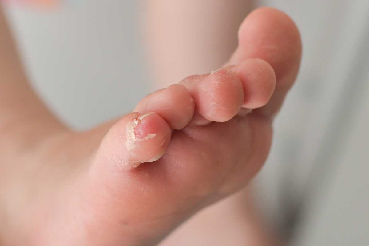 Mani-piedi-bocca: cos'è, contagio, cause, sintomi, cure e prevenzione 6 mani-piedi-bocca-complicazioni