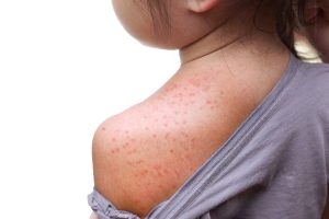 Sesta malattia: cos&rsquo;&egrave;, sintomi, contagio e cure
