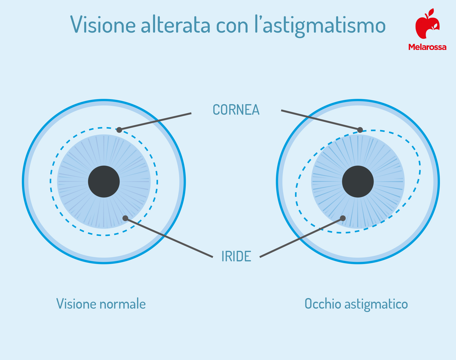 Astigmatismo: cos'è, cause, sintomi, diagnosi e cure 3 astigmatismo: visione alterata